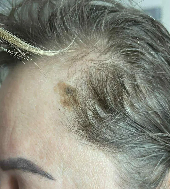 Apgamo šalinimo procedūra Saulė Ra dermatologijos klinikoje