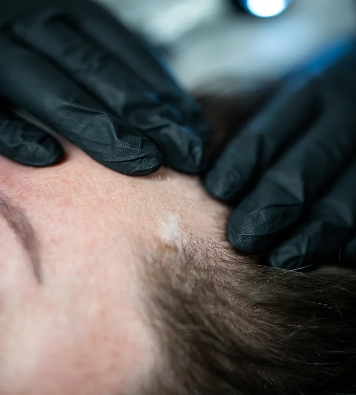 Apgamo šalinimo procedūra Saulė Ra dermatologijos klinikoje