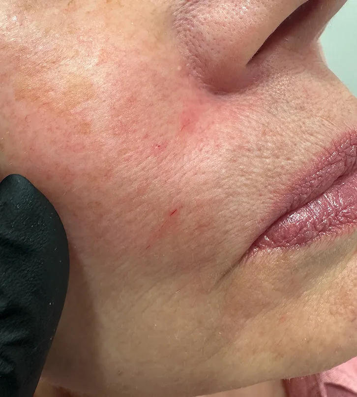 Botulino toksino injekcijos mimikos raukšlių mažinimui Saulė Ra dermatologijos klinikoje