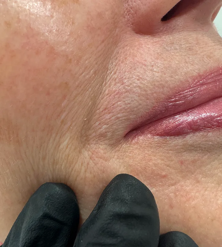 Botulino toksino injekcijos mimikos raukšlių mažinimui Saulė Ra dermatologijos klinikoje