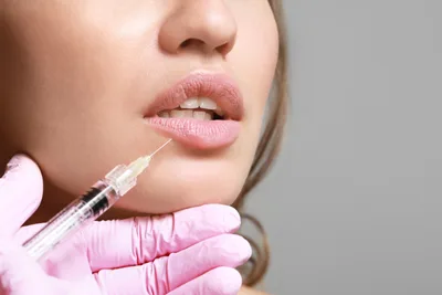 Natural lip enhancement with hyaluronic fillers. Classic technique and hyaluronidase correction at Saulė RA Clinic, London.