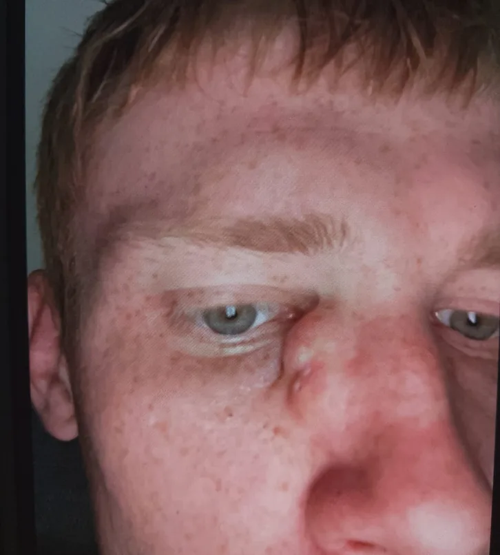 ateroma prie nosies šalinimas anglijoje