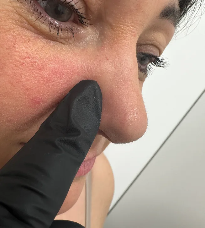 pasalinta fibroma